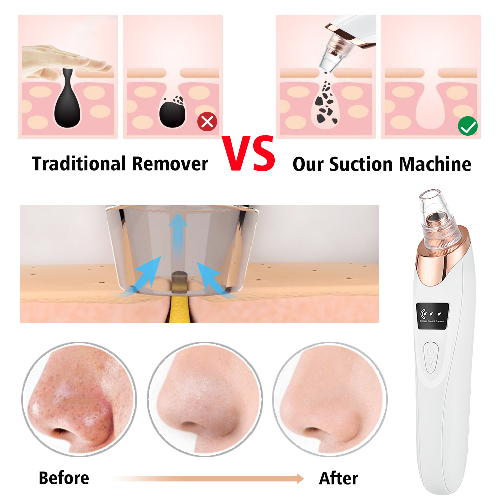 にきびやにきび用の掃除機,毛穴をきれいにするフェイシャルクレ - Pore Vacuum のレビューと価格